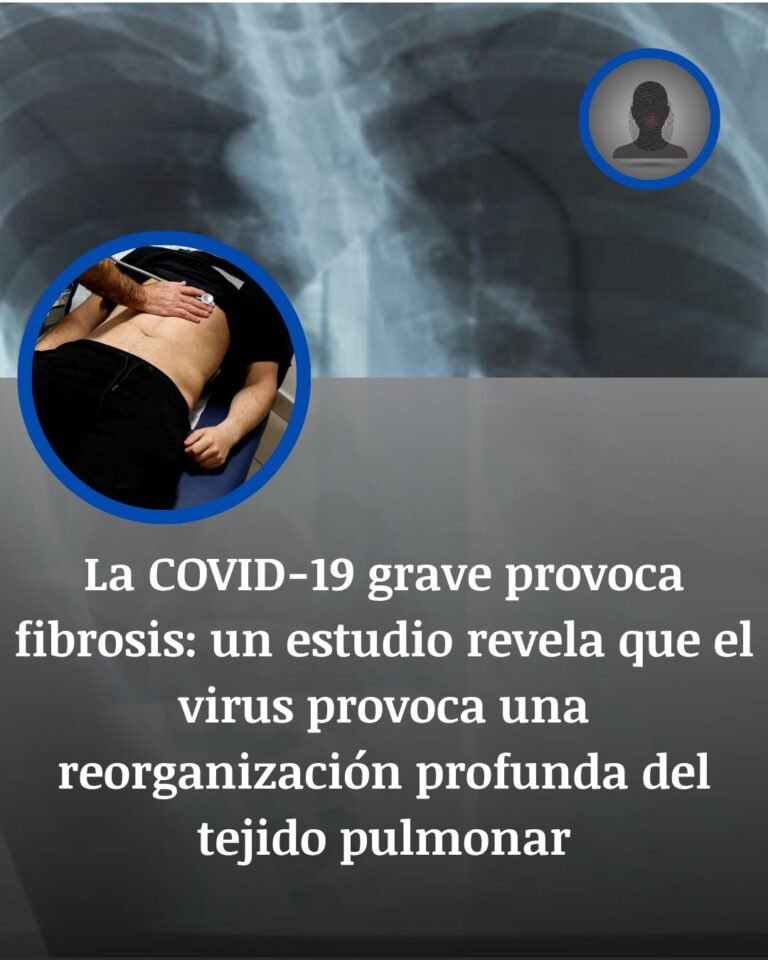 La COVID-19 grave deja al pulmón atrapado en la fibrosis: un mapa revela dónde se rompe la reparación